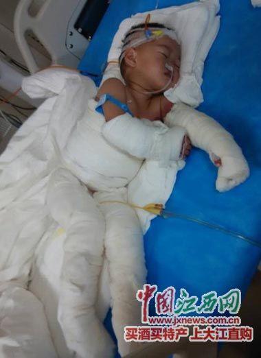 江西萍乡1岁女童被开水烫伤 四肢烧伤面积达75%