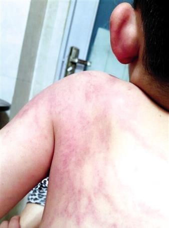 合肥：4岁儿子背部伤痕累累 被指在博澳丽苑幼儿园受伤