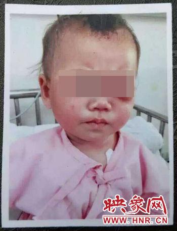 河南10个月女婴被精神病父亲用筷子戳瞎左眼