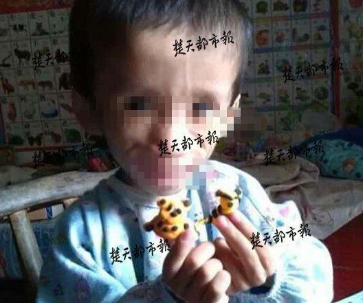 武汉一位男孩患怪病 肚子5年长成数十斤大冬瓜