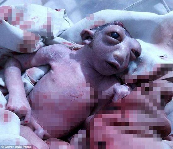 印度女婴出生仅半颗头颅双眼凸出像外星人(图)