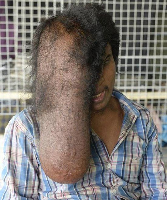 柬埔寨一名男子脸部长巨瘤 如同“象人”(图)