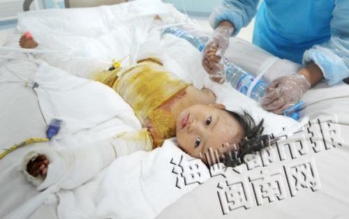 两岁半女童跌落开水锅 全身烫伤65%高烧不退